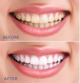 Teeth Whitening image