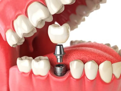 Dental Implants image