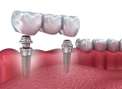 Dental Implants image