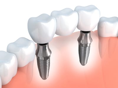 Dental Implants image