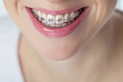 Braces &amp; Dentures image
