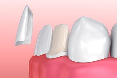 Laminates &amp; Veneers image