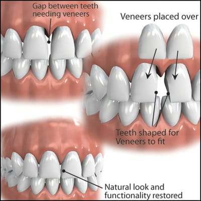 Laminates &amp; Veneers image