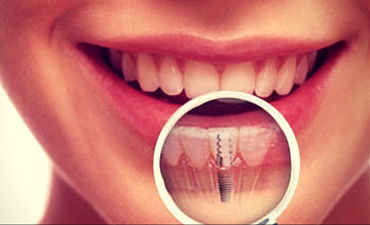 Painless Root Canal image