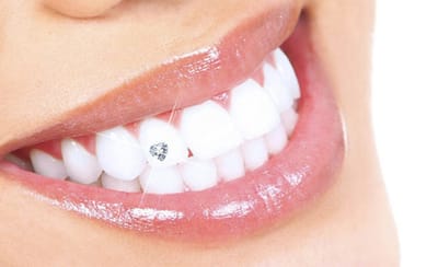 Dental Jewellery image
