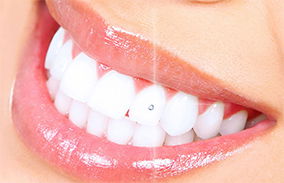 Dental Jewellery image