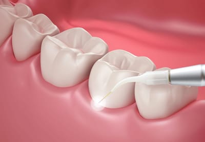 Laser Dentistry image