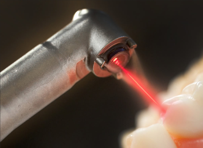 Laser Dentistry image