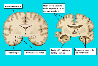 Conoce que áreas del cerebro se ven implicadas con la enfermedad del Alzheimer