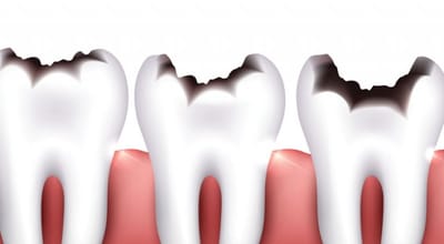 Diş Çürüğü Hakkında Bilmeniz Gerekenler