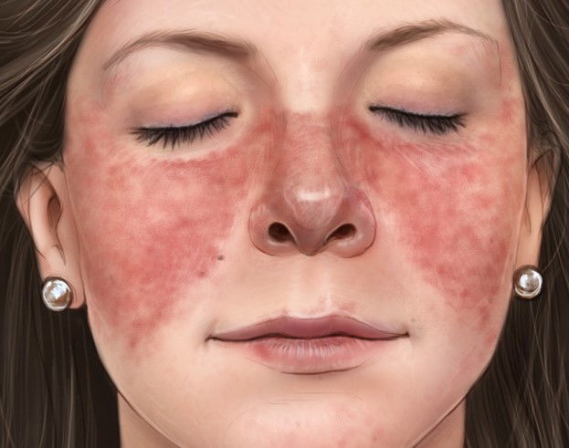 Lupus Eritematoso Sistémico