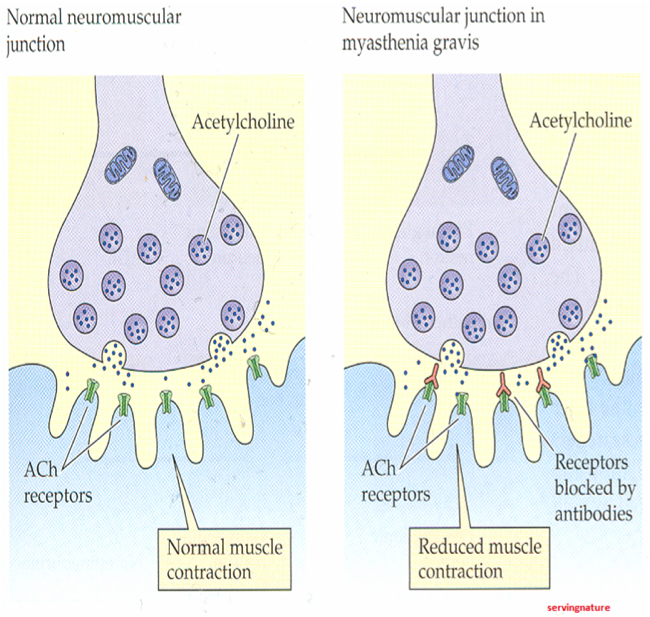 Myasthenia Gravis (MG)