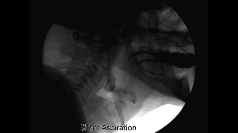 Neurology of Silent Aspiration