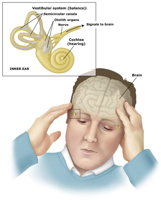 Vestibular Disorders