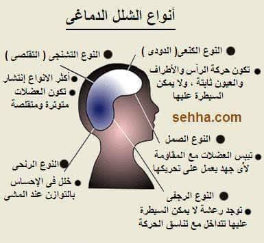 احدي امراض الجهاز العصبي