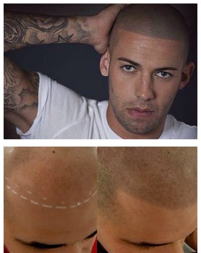 Micropigmentacion capilar