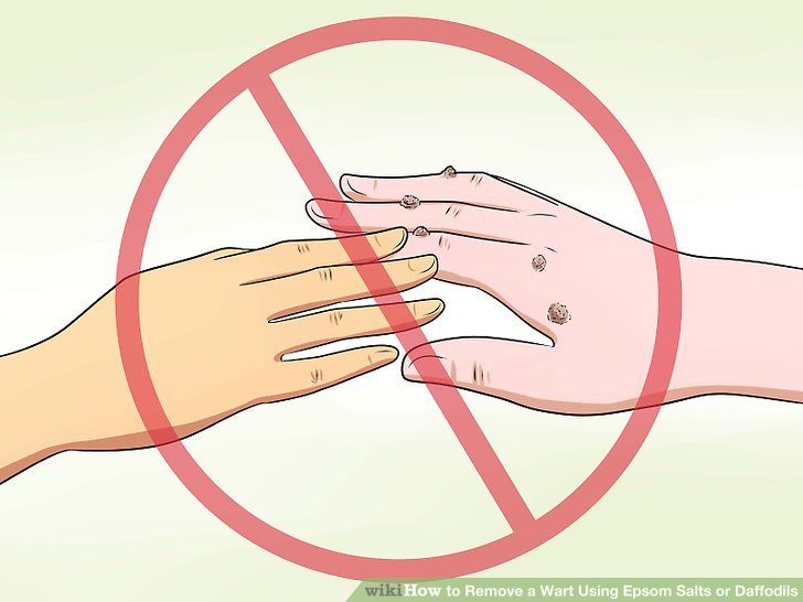 ZEL'S WARTS REMOVAL