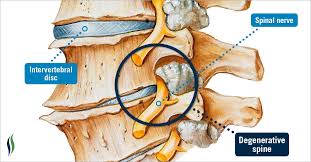 Thoái hóa cột sống tiếng anh là gì? Triệu chứng và cách điều trị