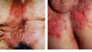 obat gatal selangkangan tinea cruris menahun paling ampuh