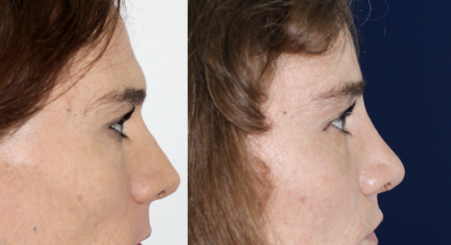 remodelage frontal, liplift, rhinoplastie