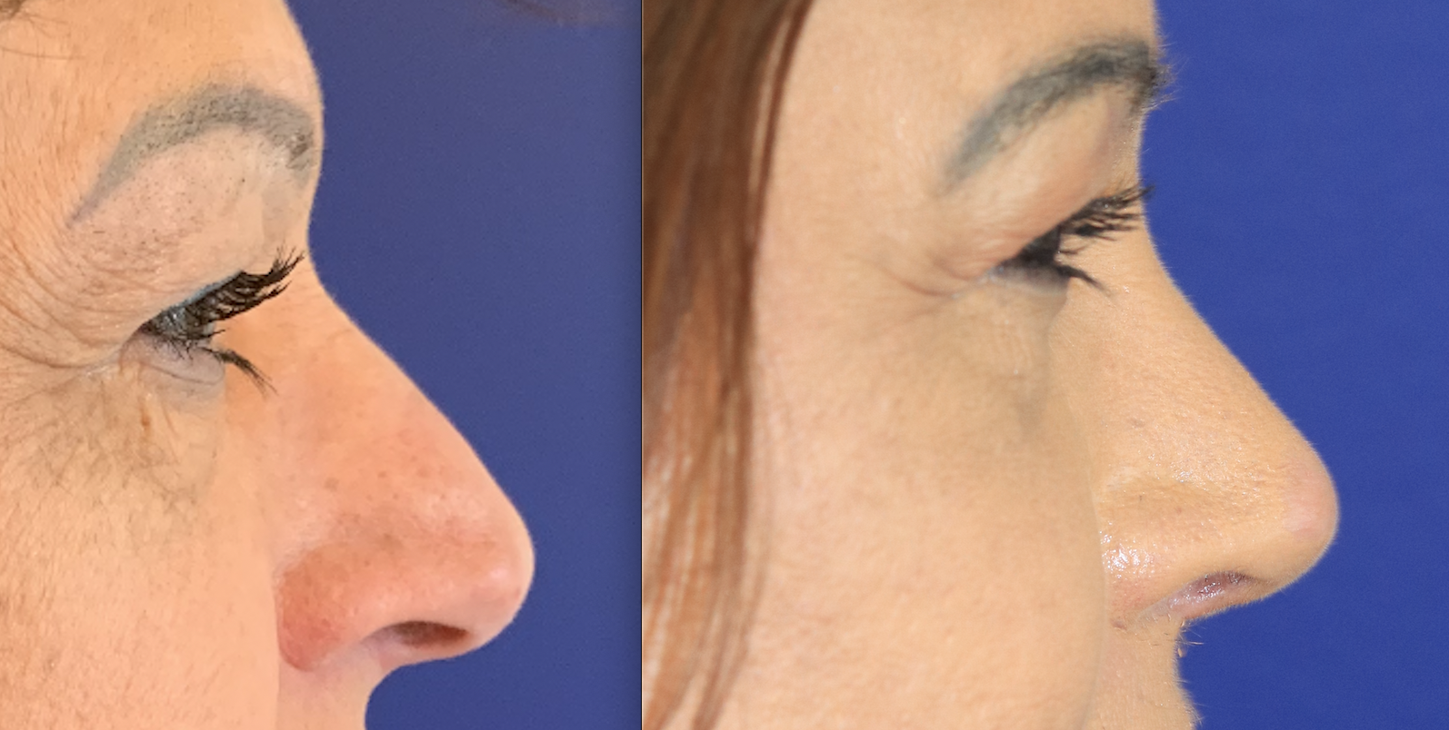 cranioplastie frontale et rhinoplastie de réduction