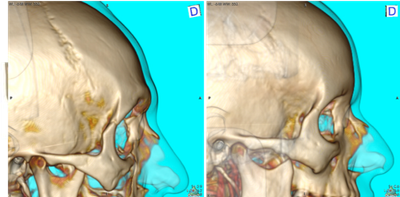 Cranioplastie fronto-orbitaire de féminisation