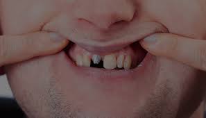 What are the Processes for Recovering After Dental Surgery and Reasons for Dental Implant Failure?