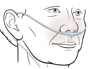 Técnicas de administración de oxígeno Administración de oxígeno por cánula nasal image