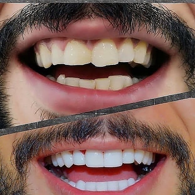 ما هي ابتسامة هوليود؟