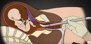 Surgical abortion