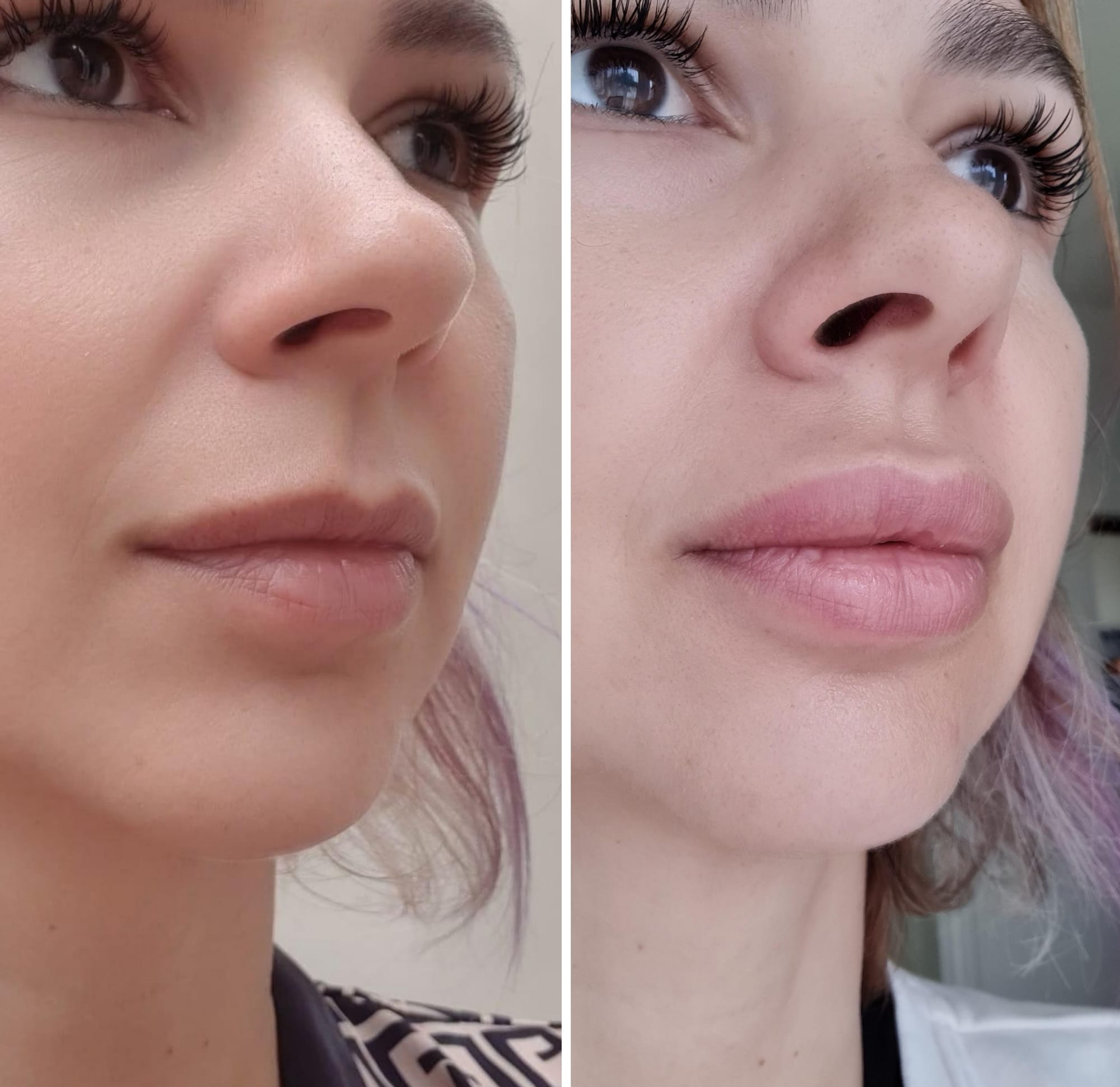 Fillers (Hyaluronic Acid)