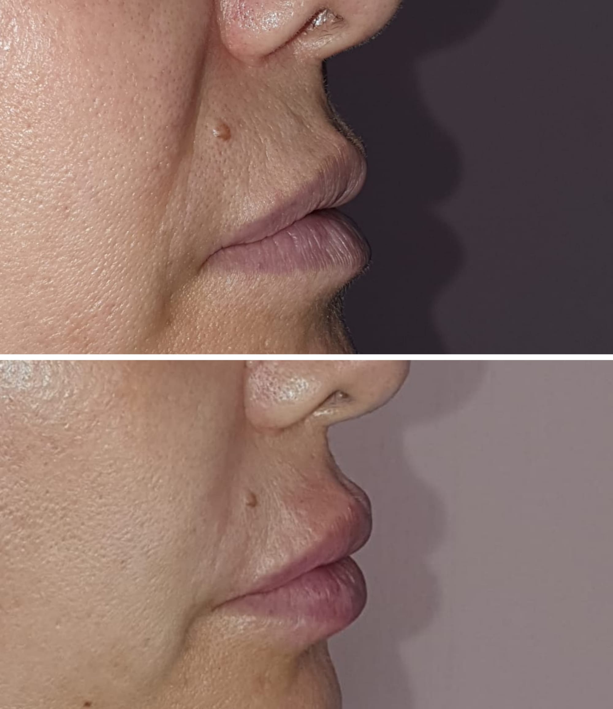 Fillers (Hyaluronic Acid)