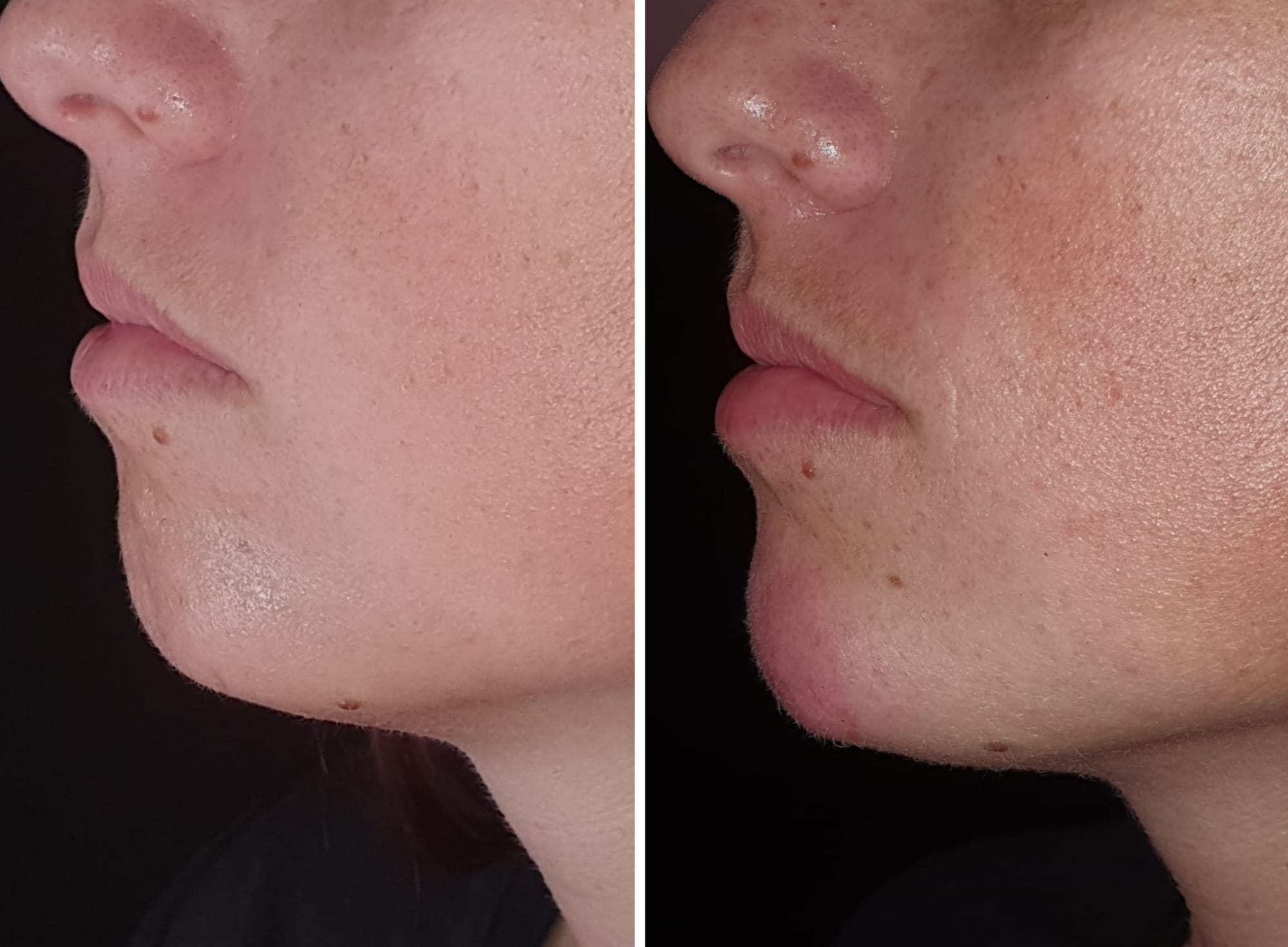 Fillers (Hyaluronic Acid)