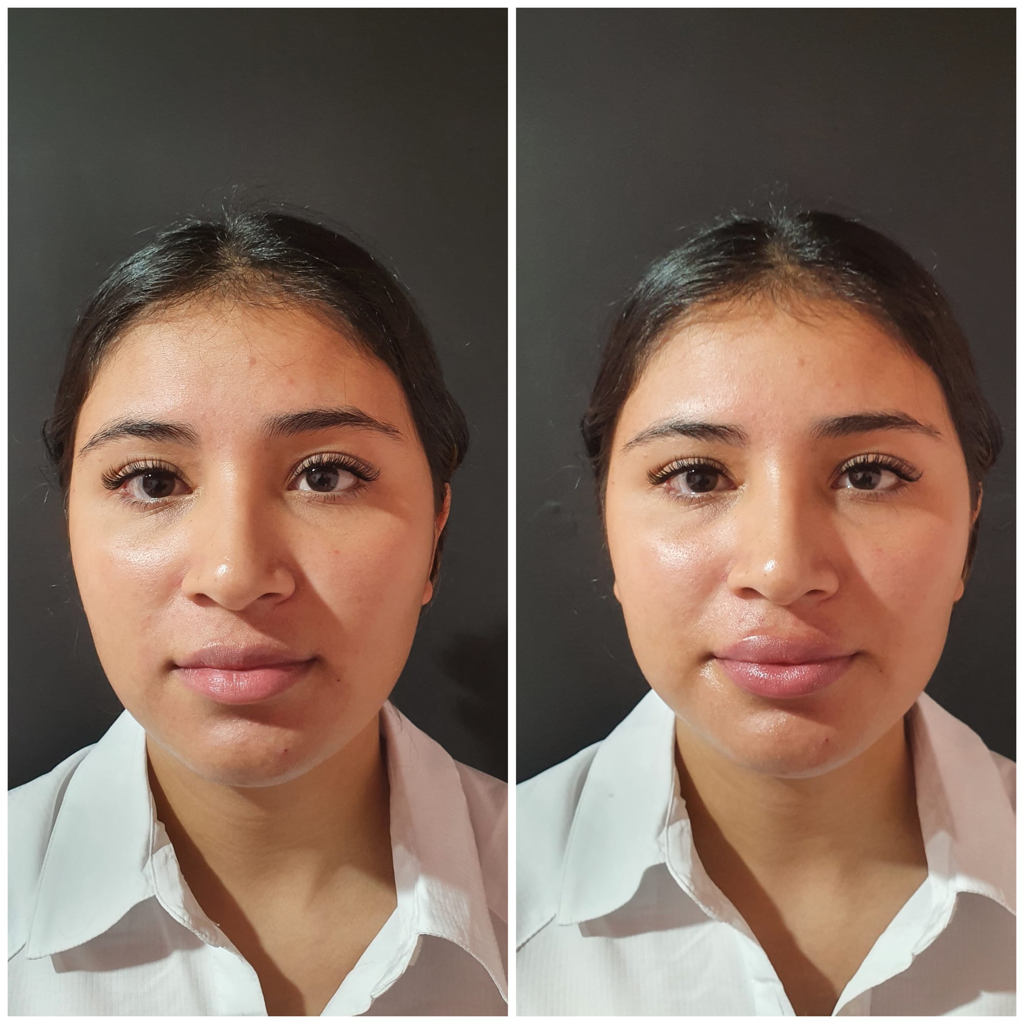 Fillers (Hyaluronic Acid)