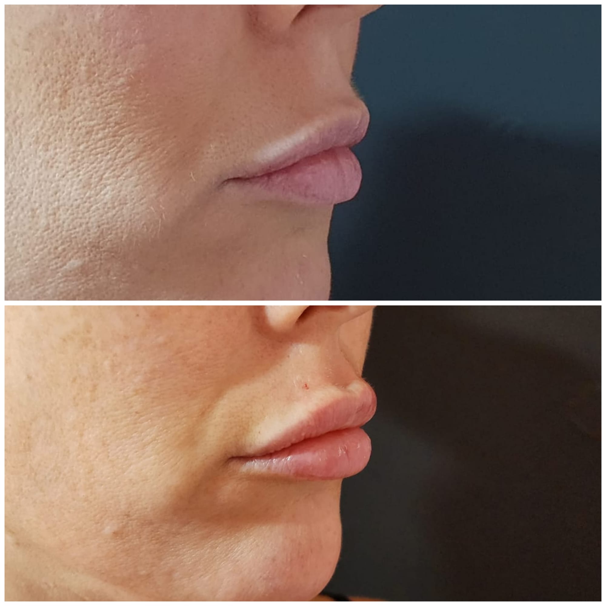 Fillers (Hyaluronic Acid)