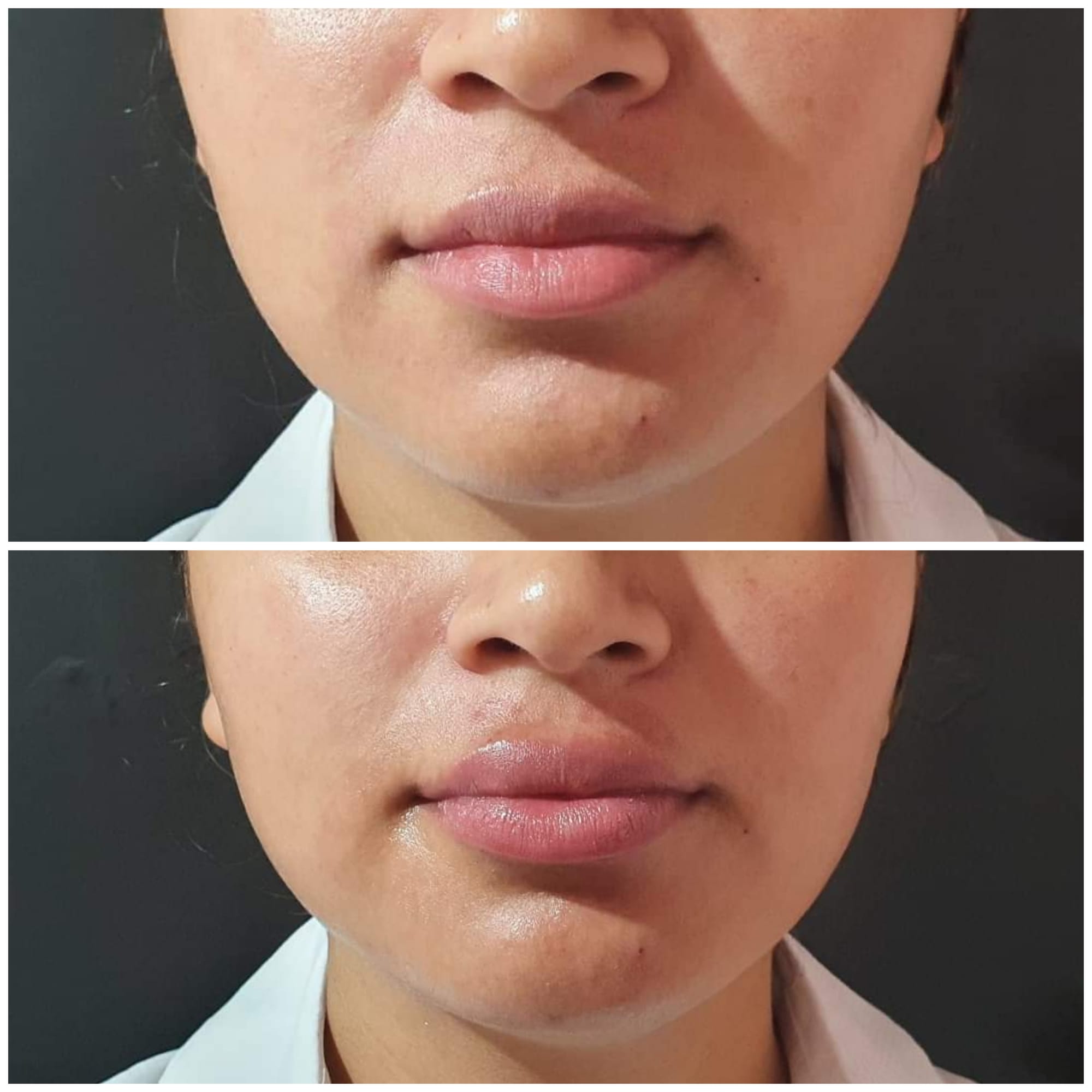 Fillers (Hyaluronic Acid)