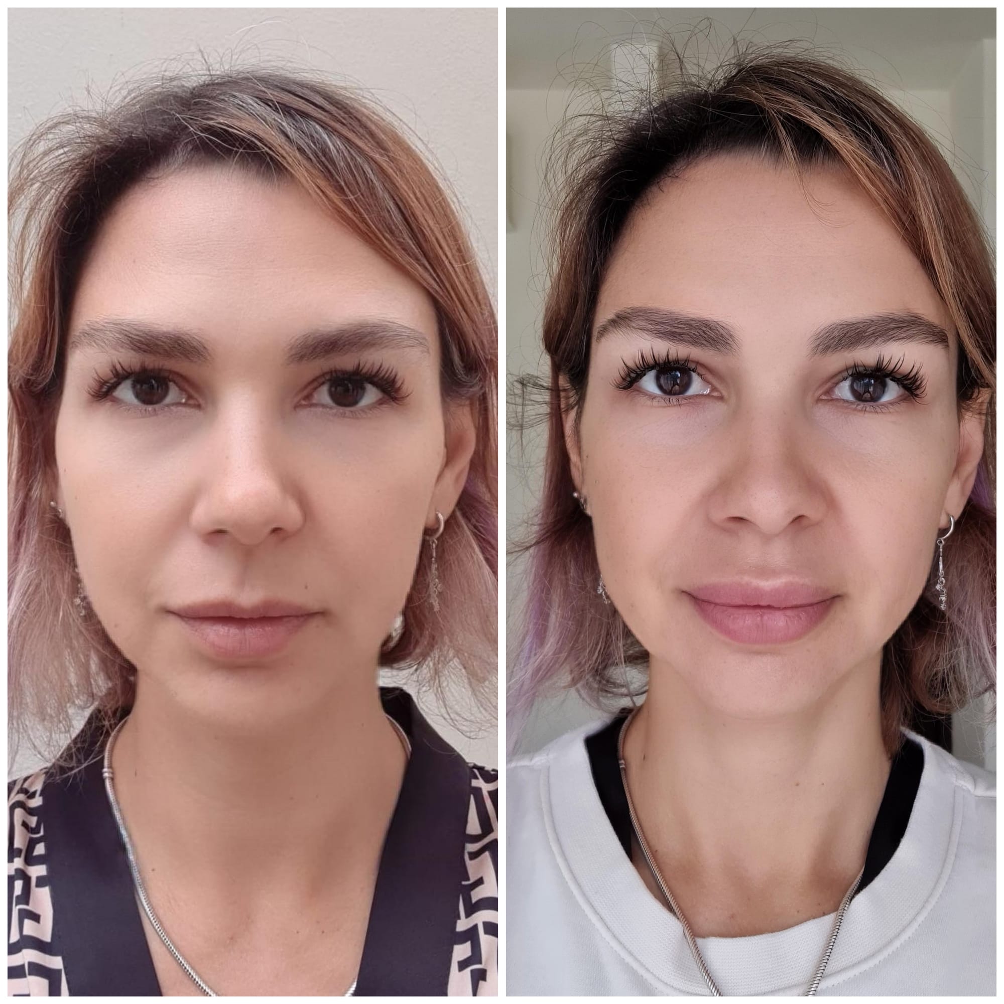 Fillers (Hyaluronic Acid)