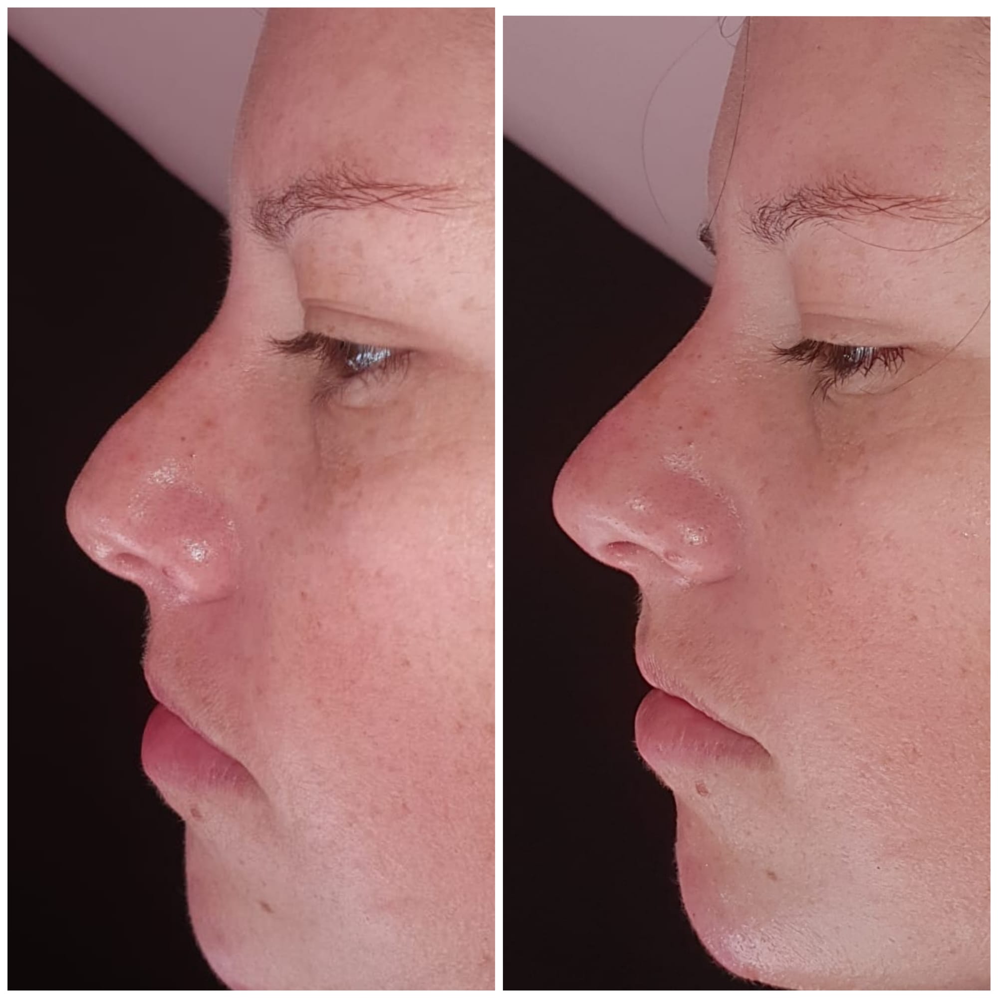 Fillers (Hyaluronic Acid)