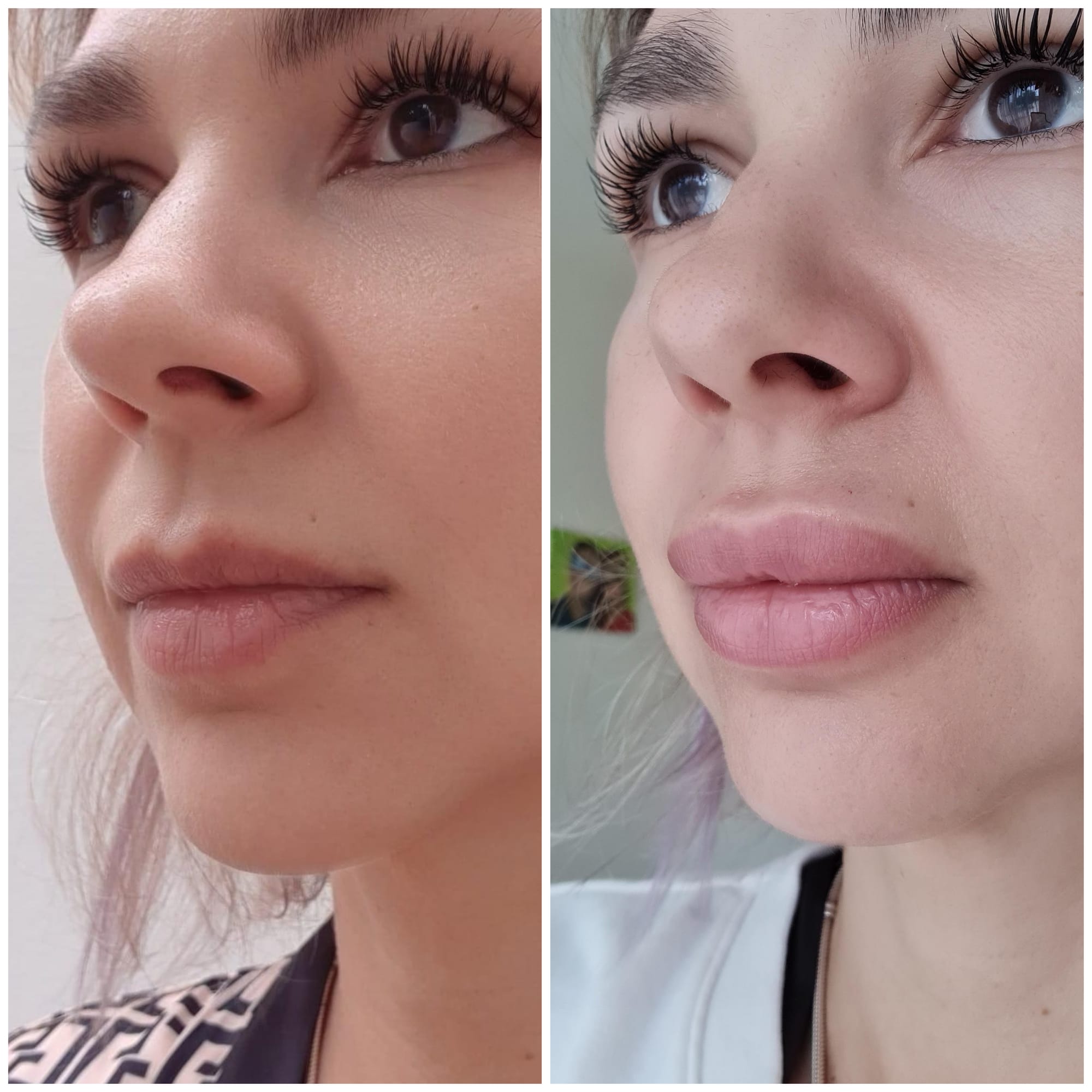 Fillers (Hyaluronic Acid)