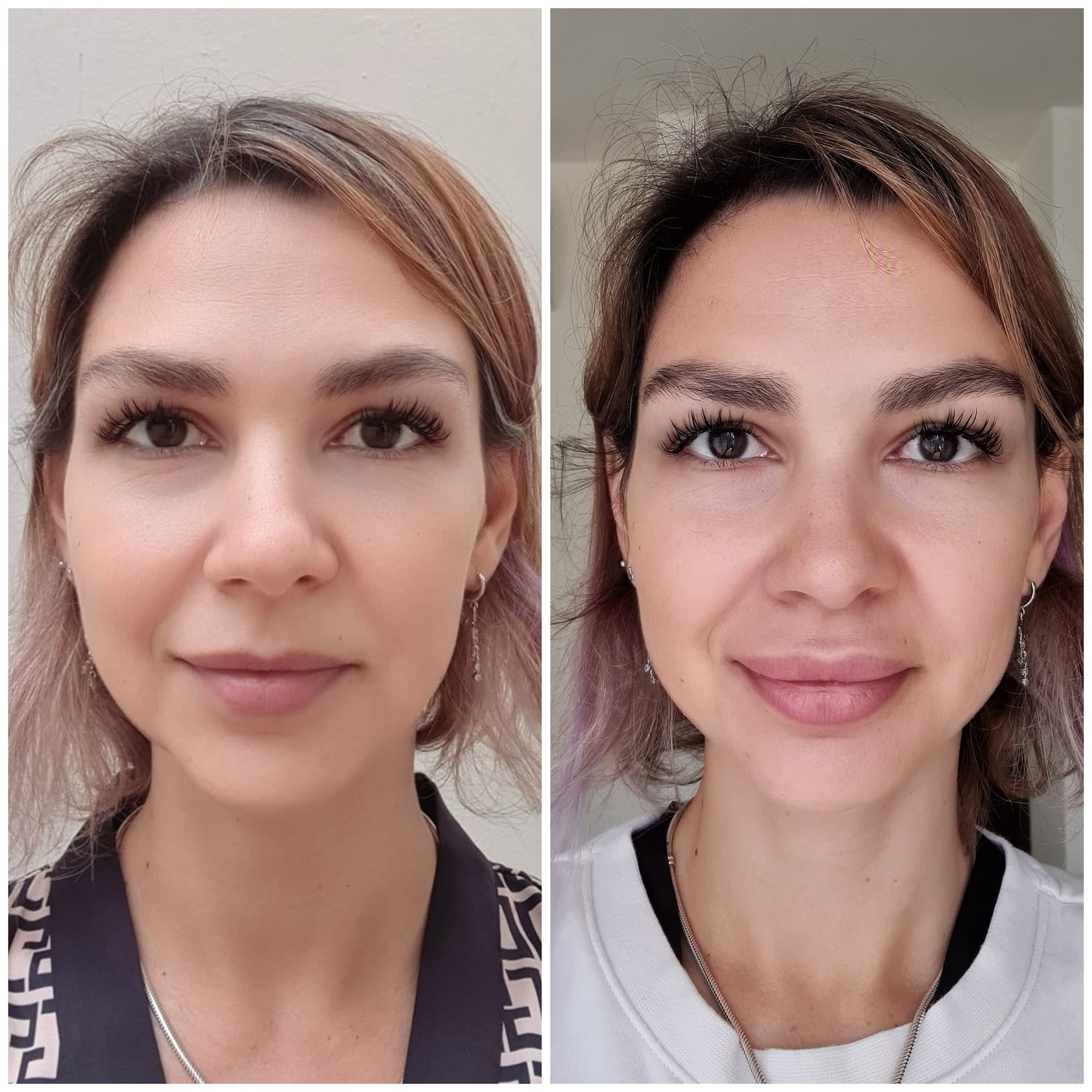 Fillers (Hyaluronic Acid)