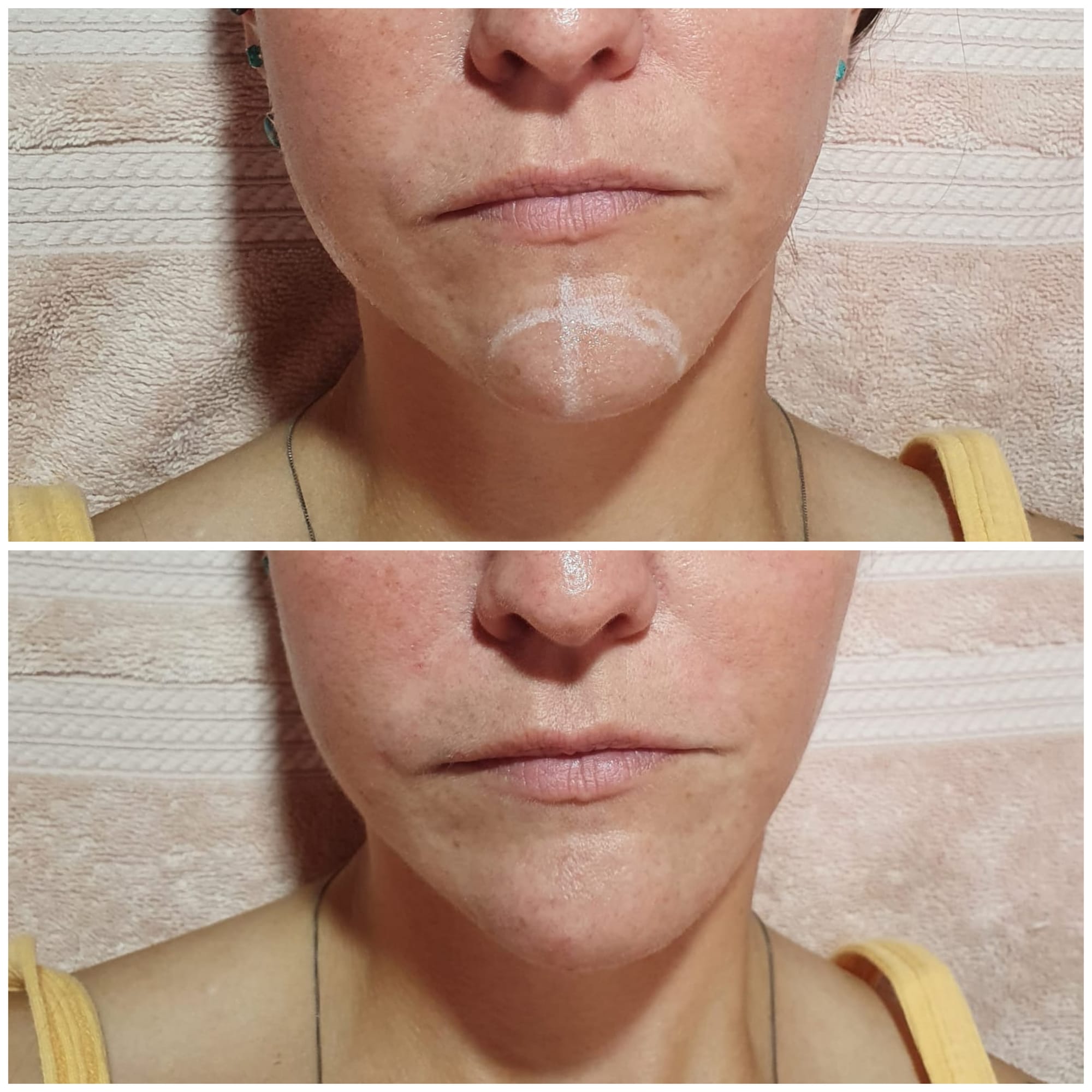 Fillers (Hyaluronic Acid)