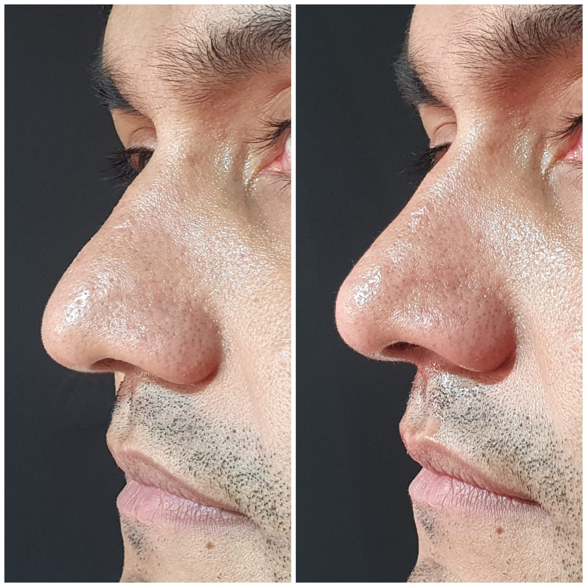 Fillers (Hyaluronic Acid)