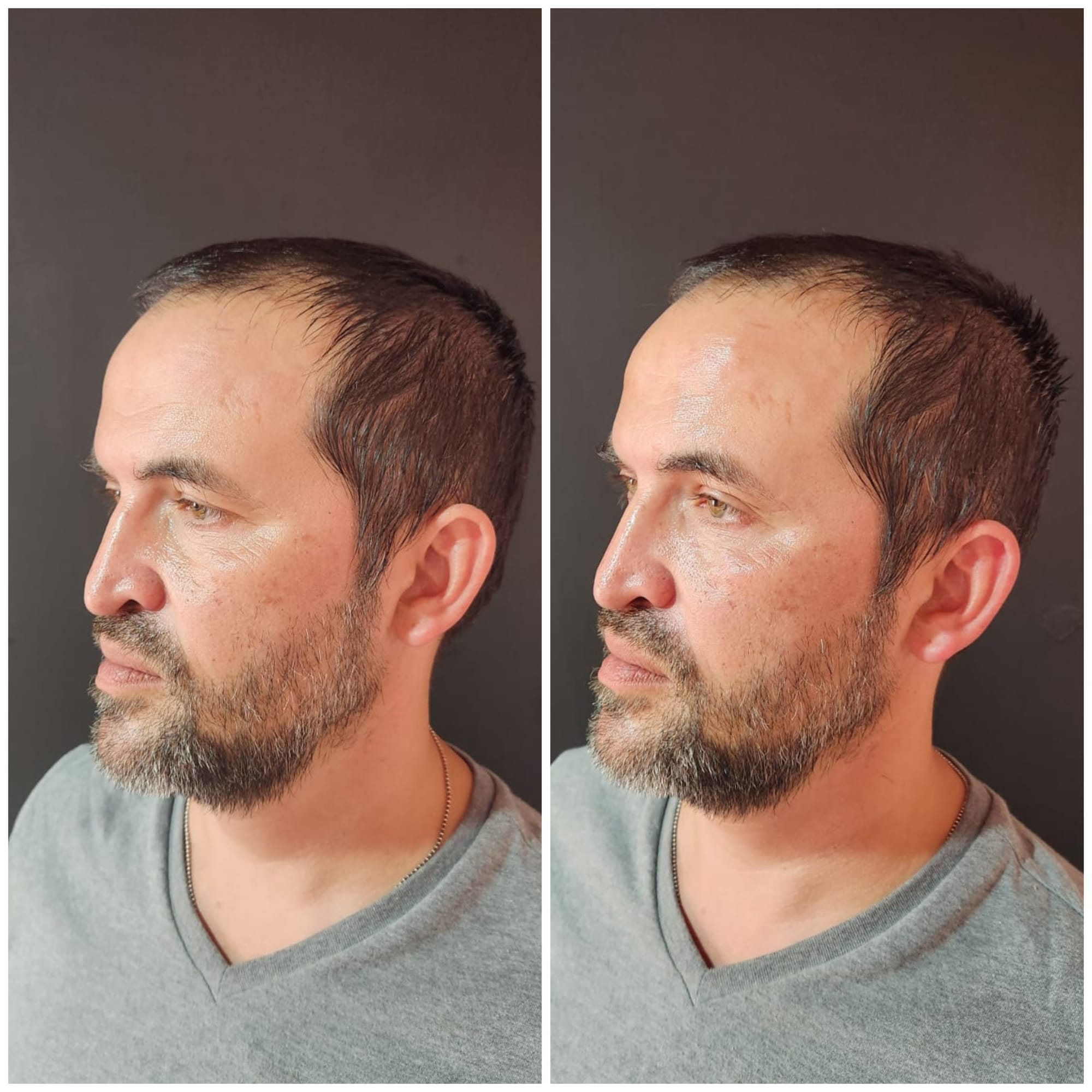 Fillers (Hyaluronic Acid)