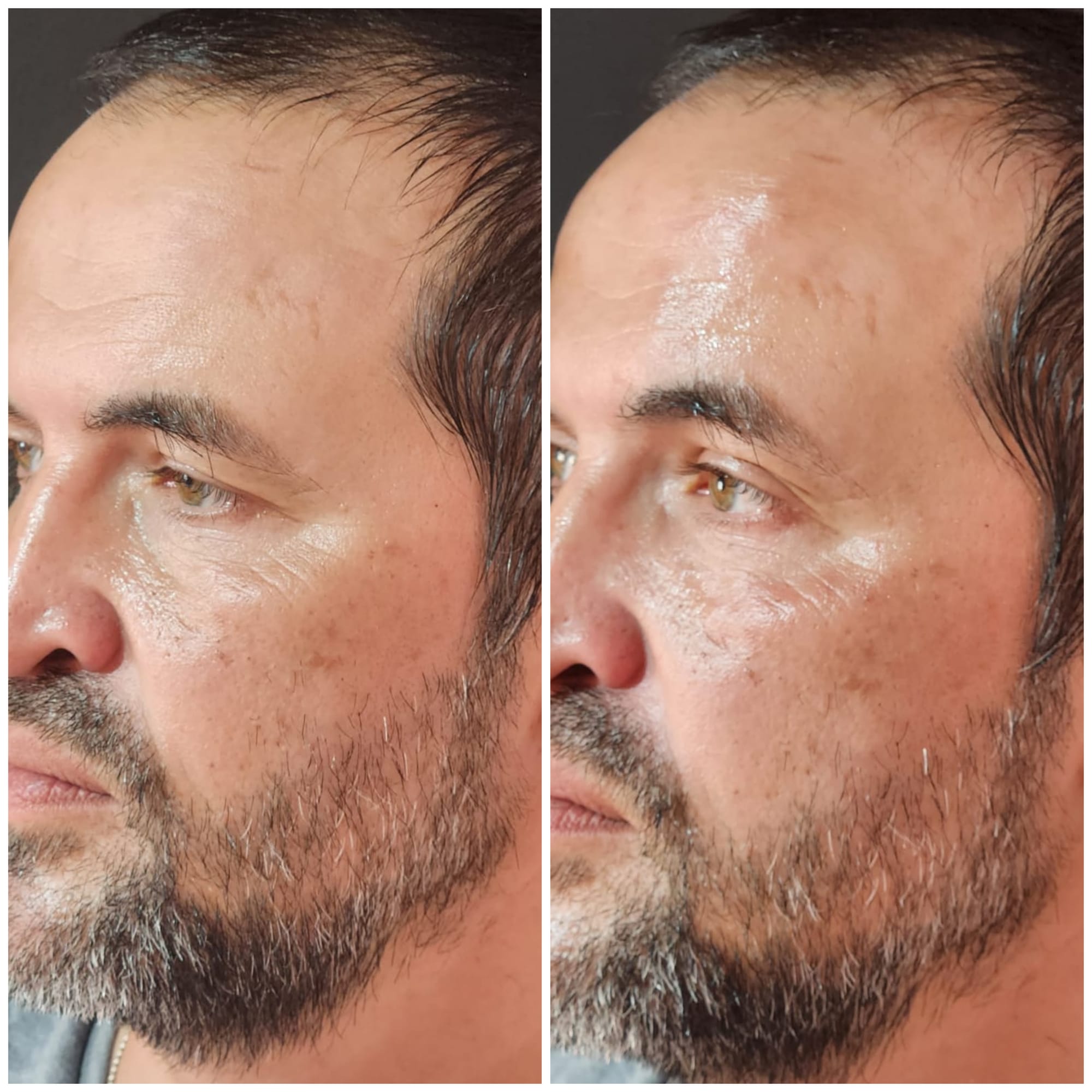 Fillers (Hyaluronic Acid)