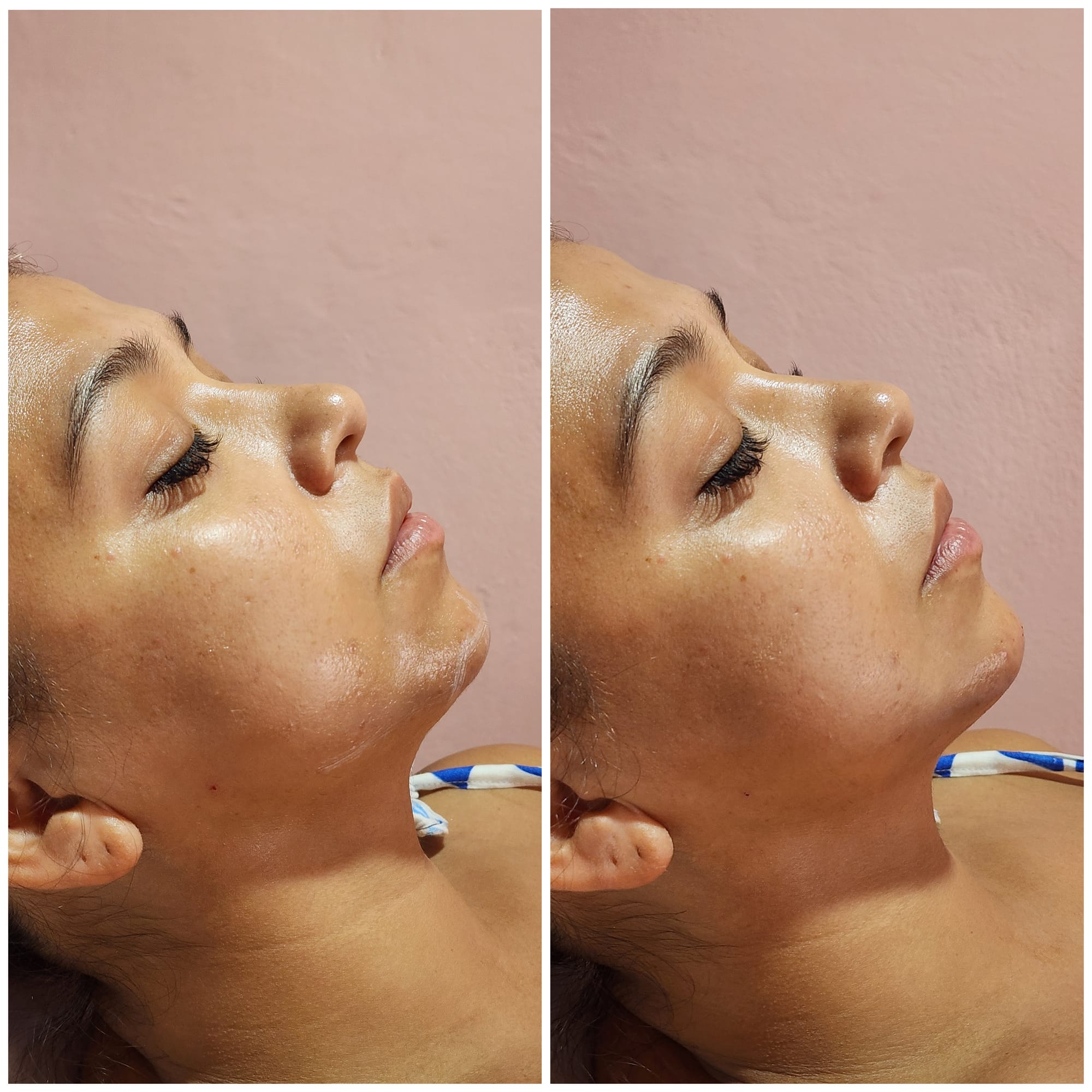 Fillers (Hyaluronic Acid)