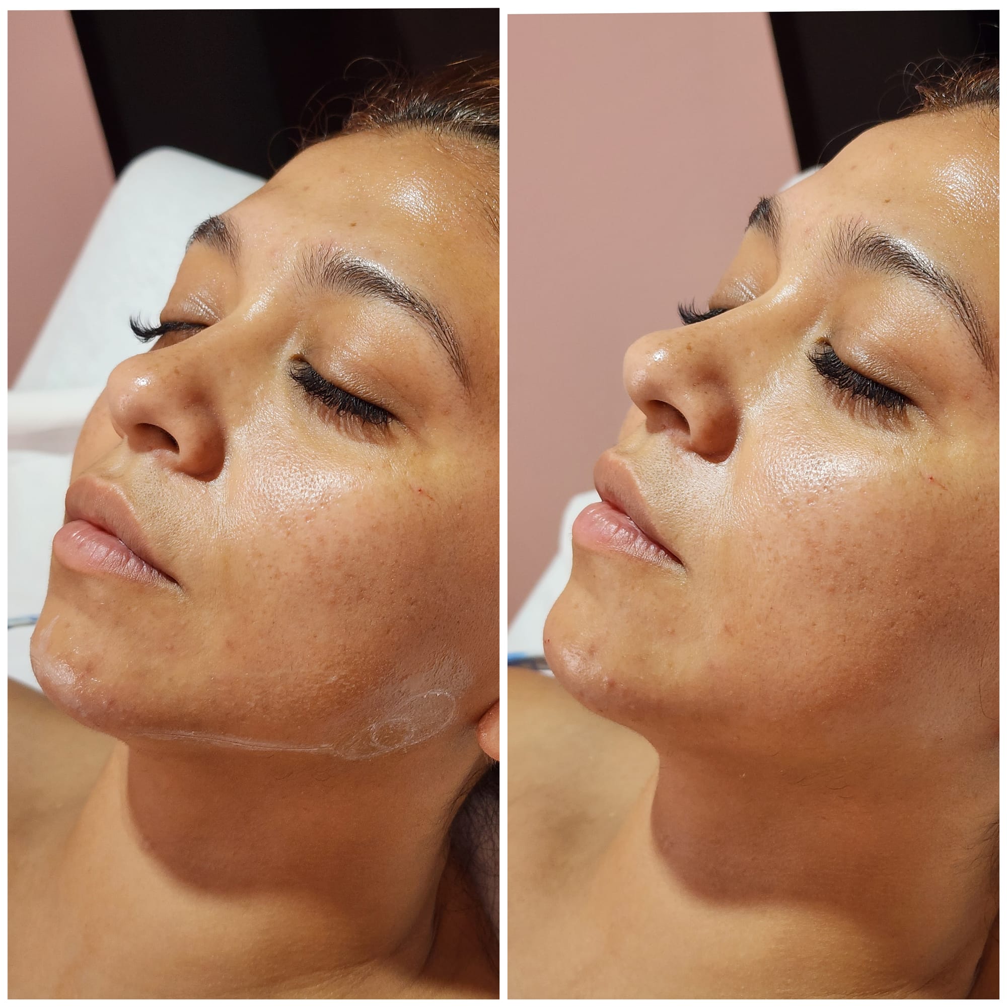 Fillers (Hyaluronic Acid)