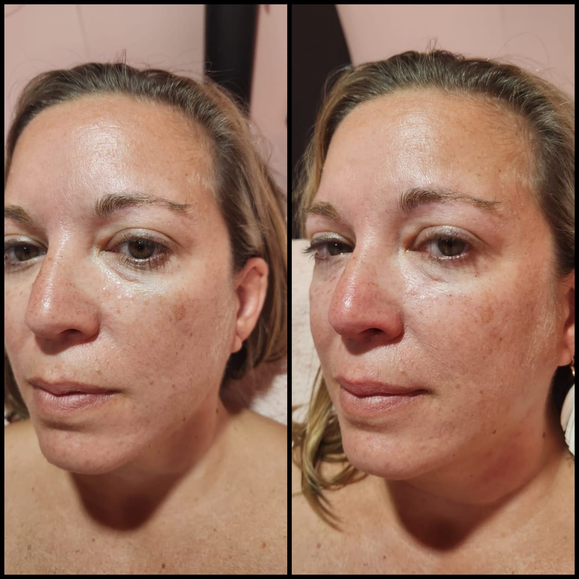 Fillers (Hyaluronic Acid)