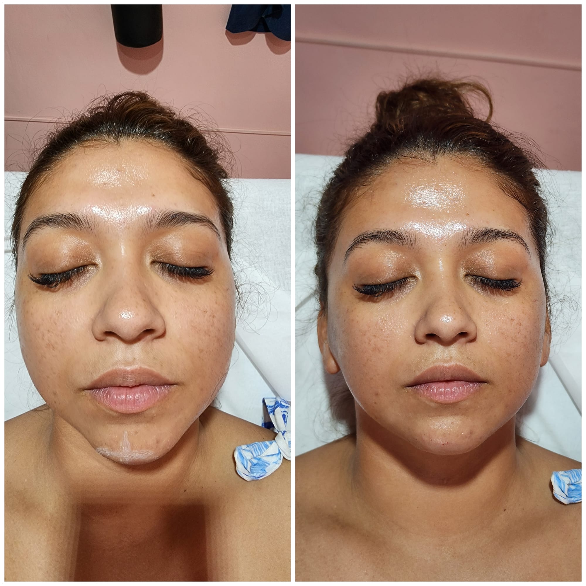 Fillers (Hyaluronic Acid)