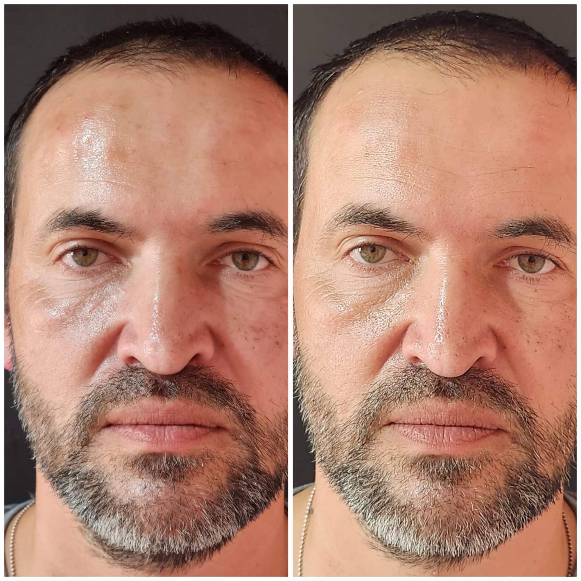 Fillers (Hyaluronic Acid)