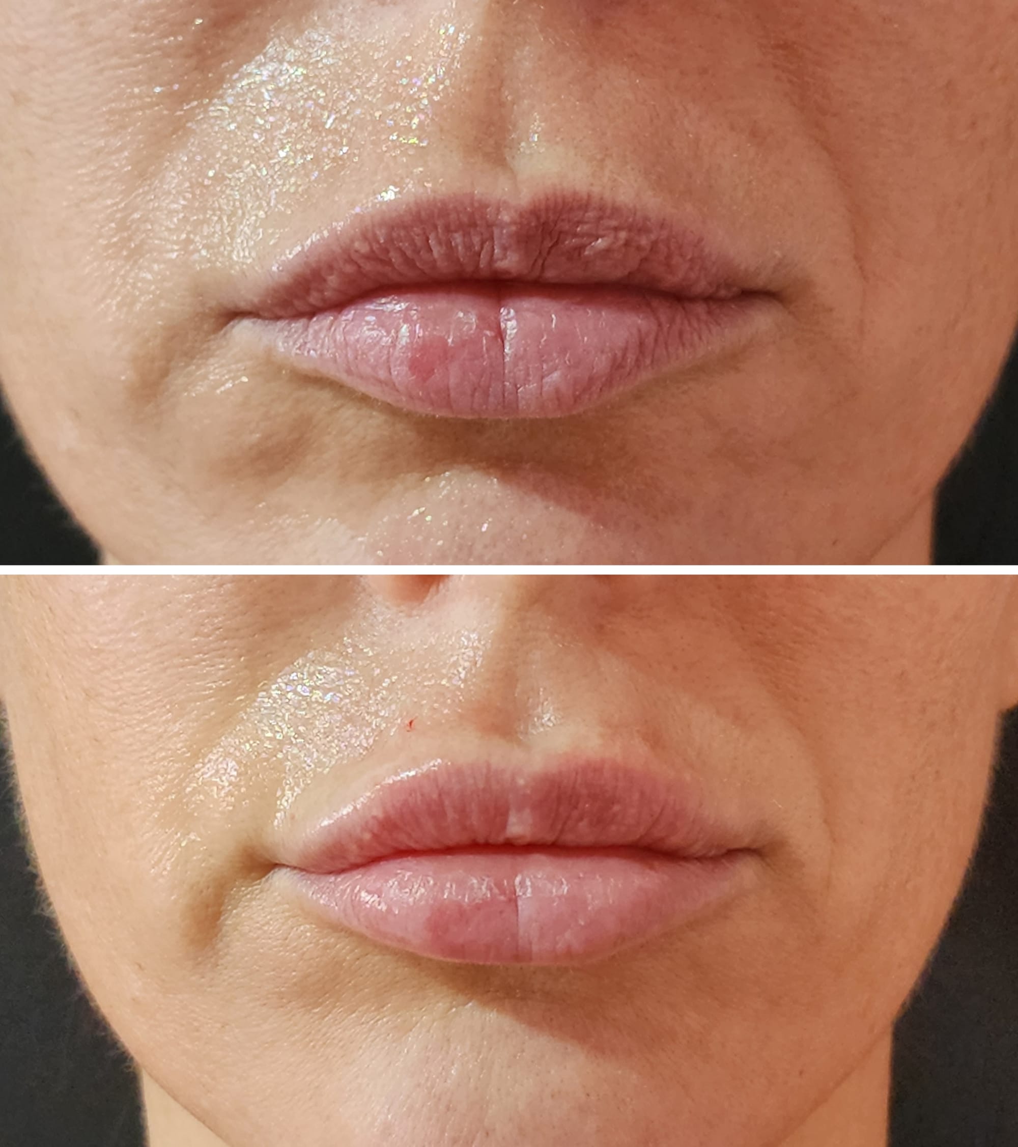 Fillers (Hyaluronic Acid)